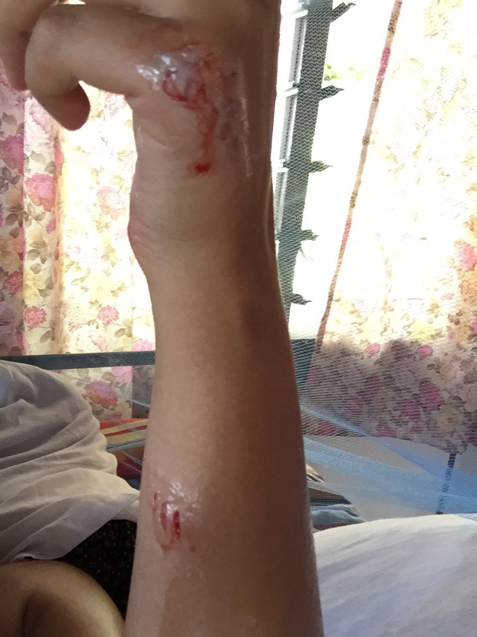 Yasemins Arm nach dem Haibiss